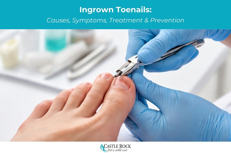 Ingrown Toenails: Causes, Symptoms, Treatment & Prevention